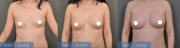 自體脂肪隆乳案例分享A罩杯正面照