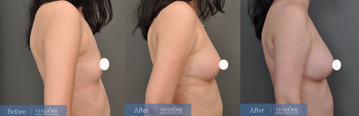 自體脂肪隆乳案例分享A罩杯側面照