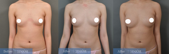 自體脂肪隆乳案例分享B罩杯正面照