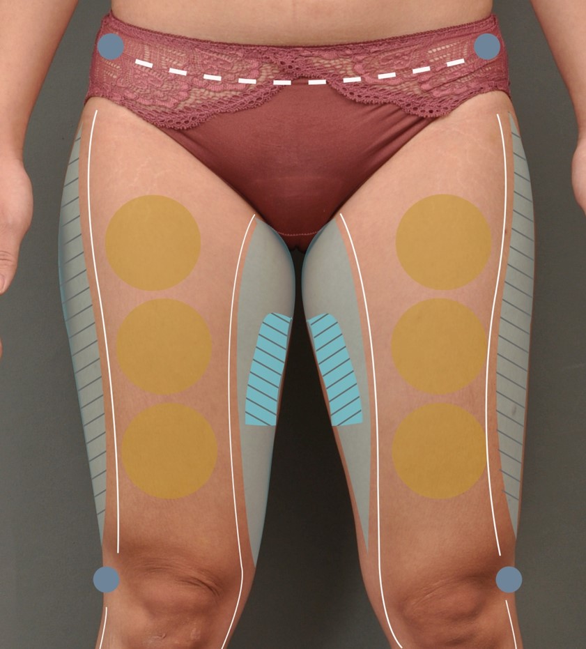 大腿抽脂注意事項有哪些？