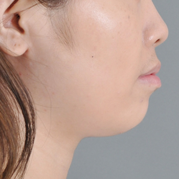 下巴太平，臉型較不立體