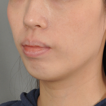 下巴嚴重後縮或過短