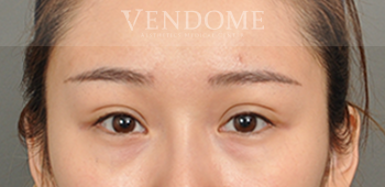 消除眼袋手術、眼袋手術術前案例