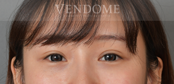 消除眼袋手術、眼袋手術術後案例