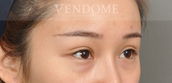 無痕眼袋手術術前案例