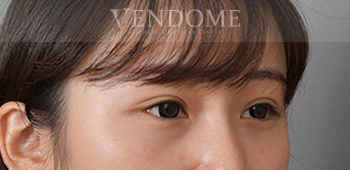 無痕眼袋手術術後案例