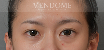 眼袋手術推薦、眼袋手術術前案例