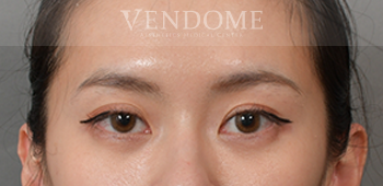 眼袋手術推薦、眼袋手術術後案例