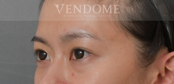 眼袋手術（眼袋內開、眼袋外開）術前案例