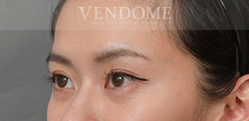 眼袋手術（眼袋內開、眼袋外開）術後案例