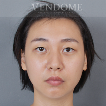 除眼袋手術術後案例