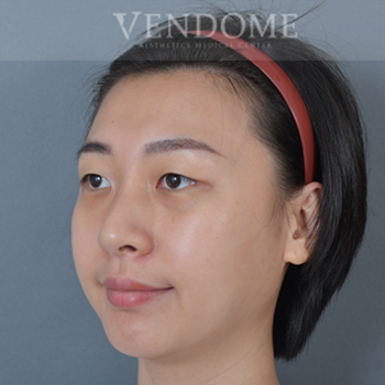 新竹眼袋手術術前案例