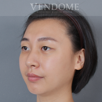 新竹眼袋手術術後案例