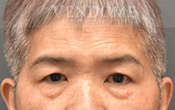 新竹眼袋手術推薦術前案例