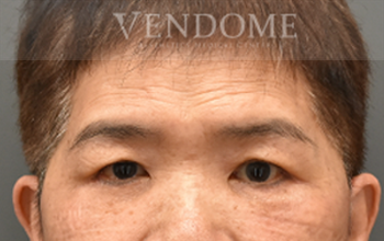 新竹眼袋手術推薦術後案例