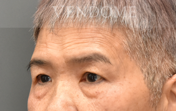 眼袋手術（眼袋內開、眼袋外開）術前案例