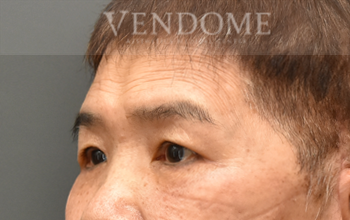 眼袋手術（眼袋內開、眼袋外開）術後案例