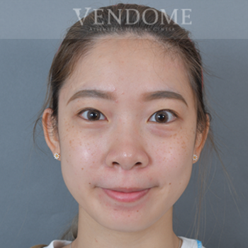 去眼袋手術術前案例