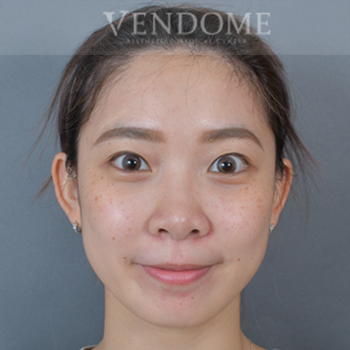 去眼袋手術術後案例