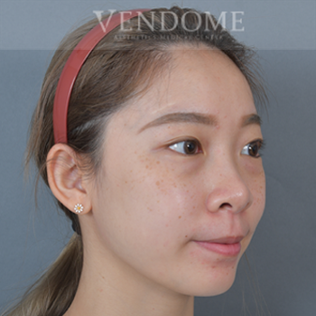 無痕去眼袋術前案例