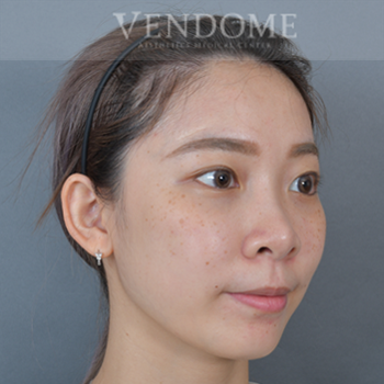 無痕去眼袋術後案例