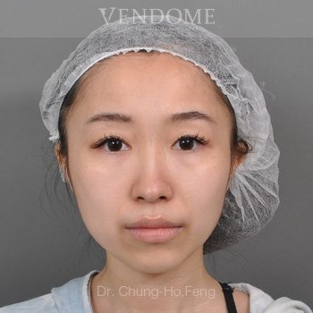 無痕眼袋手術術前案例