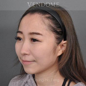 無痕眼袋手術術後案例