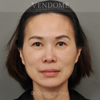 消除眼袋手術術後案例