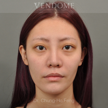 去除眼袋手術術前案例