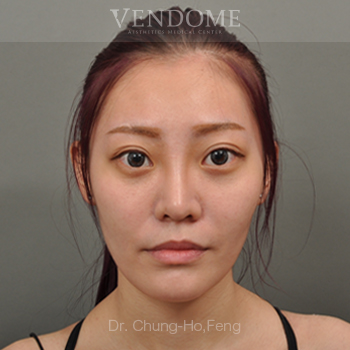 去除眼袋手術術後案例