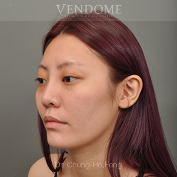 眼袋手術推薦術前案例