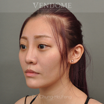 眼袋手術推薦術後案例