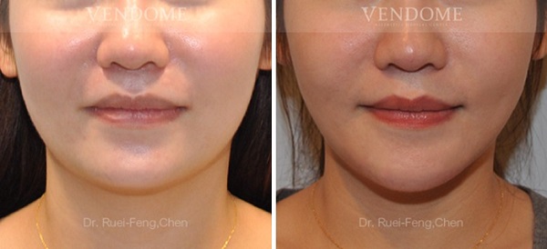 正顎手術合併下顎骨角修飾前後對比