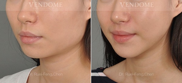 下顎骨角修順合併下巴延長前後對比