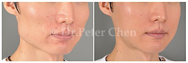 下顎骨角削骨合併顴骨截骨內推術後對比