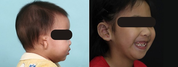 小耳症,小耳朵,小耳畸形,小耳症手術,陳潤茺醫師