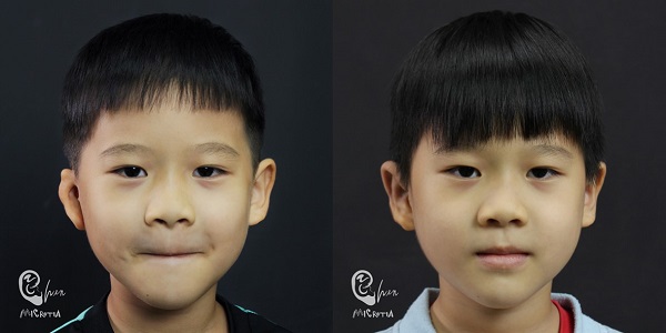 小耳症,小耳朵,小耳畸形,小耳症手術,陳潤茺醫師