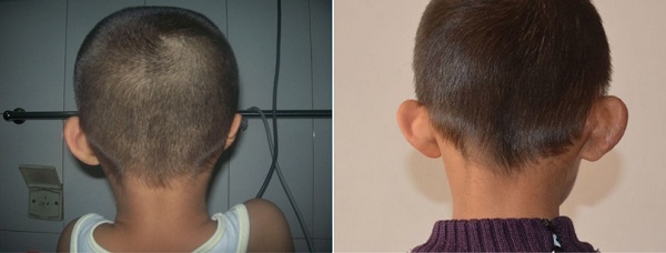 小耳症,小耳朵,小耳畸形,小耳症手術,陳潤茺醫師