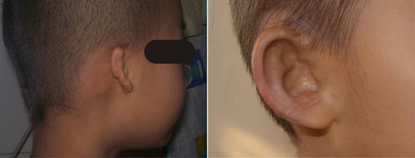 小耳症,小耳朵,小耳畸形,小耳症手術,陳潤茺醫師