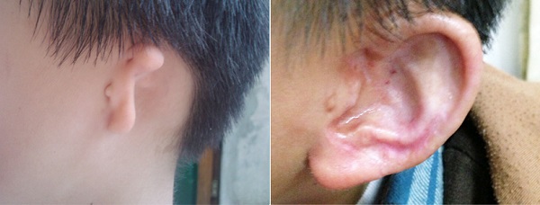 小耳症,小耳朵,小耳畸形,小耳症手術,陳潤茺醫師