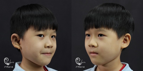 小耳症,小耳朵,小耳畸形,小耳症手術,陳潤茺醫師