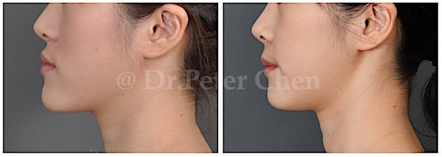 正顎手術常見臉型：下顎突出