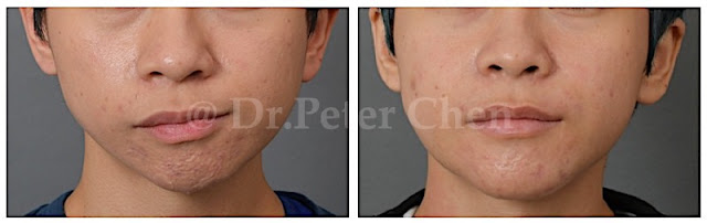 正顎手術常見臉型：歪斜不對稱