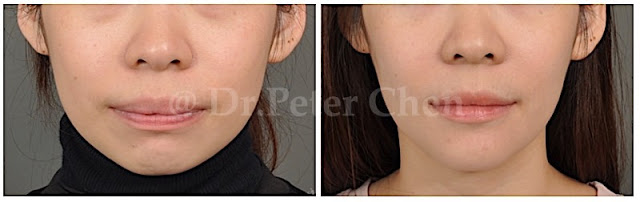 正顎手術常見臉型：上顎突出