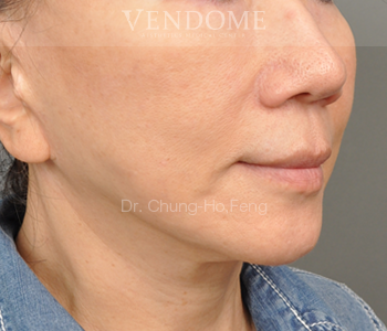 自體脂肪豐頰推薦 案例分享（後-8）  