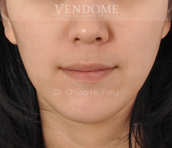 自體脂肪回填 案例分享（前-5）